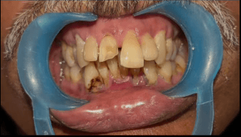 After dental treatment at Dentara