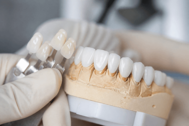 Dental crowns and veneers at Dentara